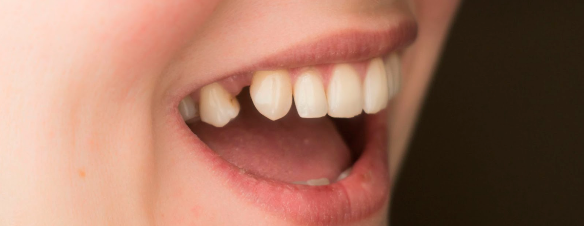 Perdi um dente e não quero fazer implante: saiba quais são as ...